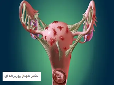 بهترین دکتر درمان تخمدان پلی کیستیک