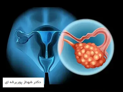 تشخیص سندرم تخمدان پلی کیستیک