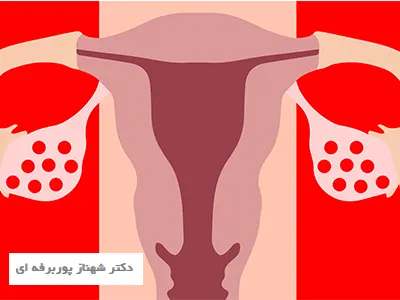 علائم سندرم تخمدان پلی کیستیک