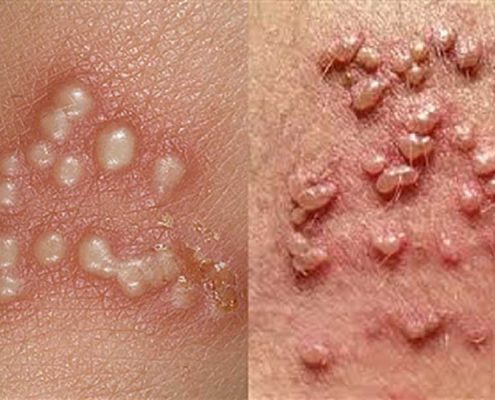 تفاوت زگیل تناسلی و تبخال تناسلی چیست؟