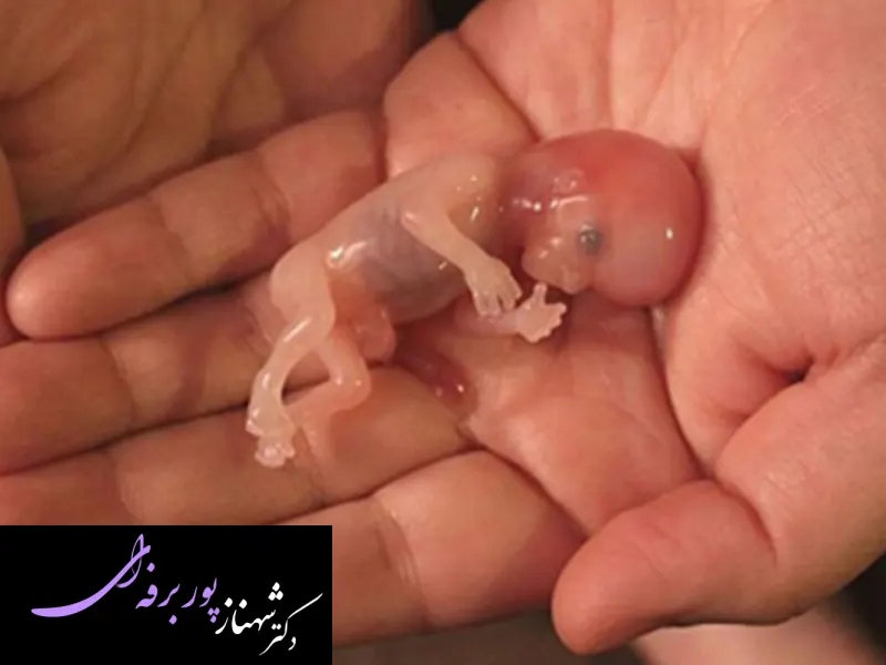 درمان بارداری خارج از رحم